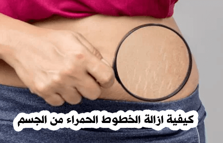 كيفية ازالة الخطوط الحمراء من الجسم
